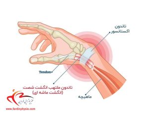 درباره این مقاله بیشتر بخوانید تاندونیت مچ دست چیست؟ + علل، نشانه و روش‌های درمان