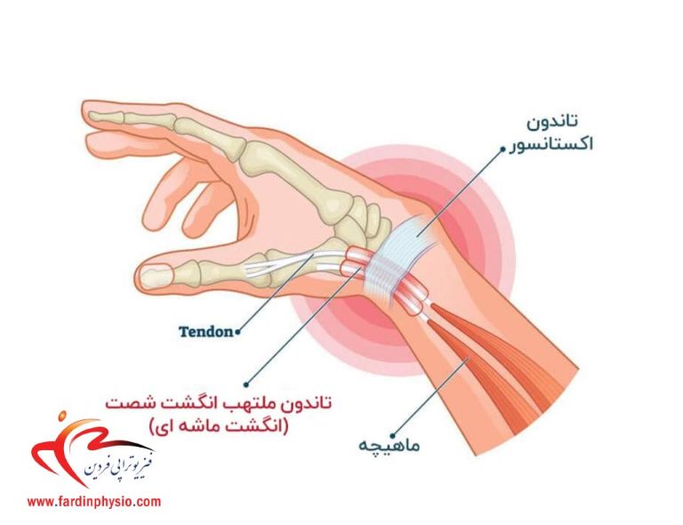 درباره این مقاله بیشتر بخوانید تاندونیت مچ دست چیست؟ + علل، نشانه و روش‌های درمان