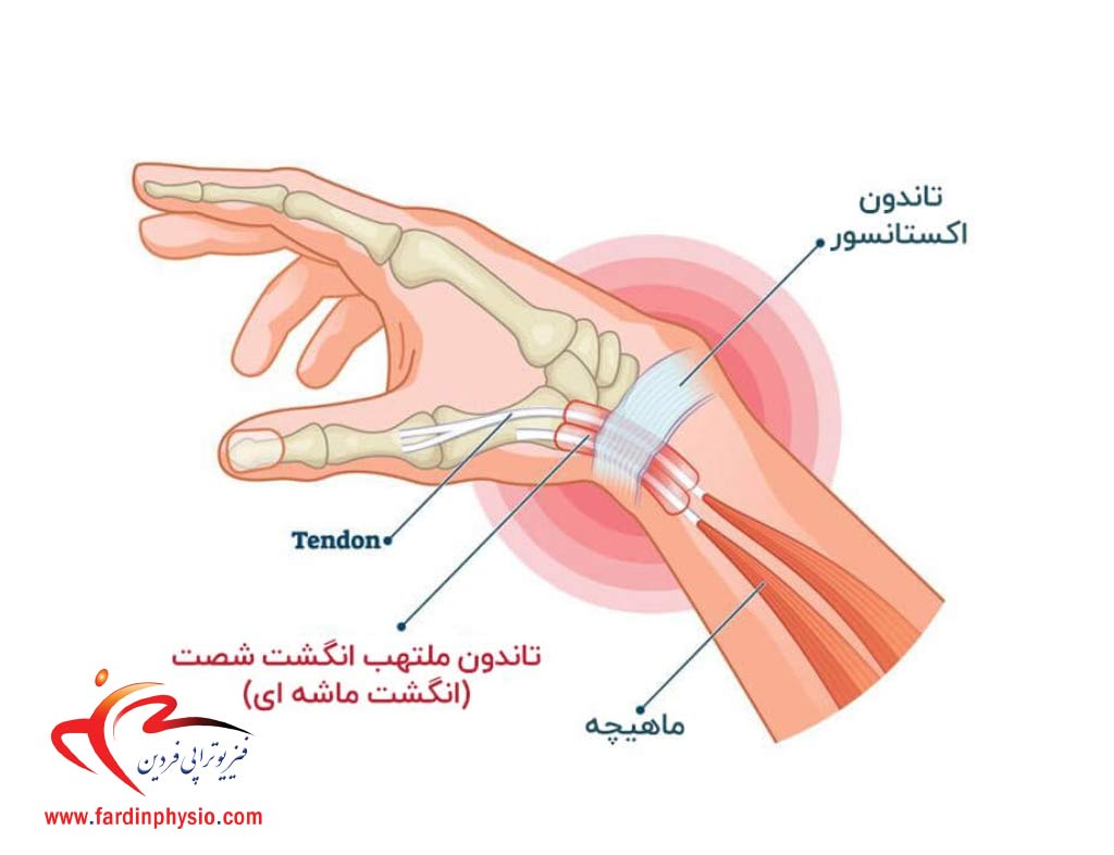 You are currently viewing تاندونیت مچ دست چیست؟ + علل، نشانه و روش‌های درمان