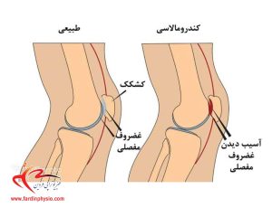 درباره این مقاله بیشتر بخوانید کندرومالاسی کشکک زانو چیست و نقش فیزیوتراپی در بهبود آن