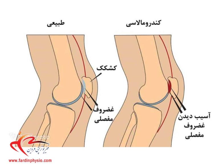 درباره این مقاله بیشتر بخوانید کندرومالاسی کشکک زانو چیست و نقش فیزیوتراپی در بهبود آن