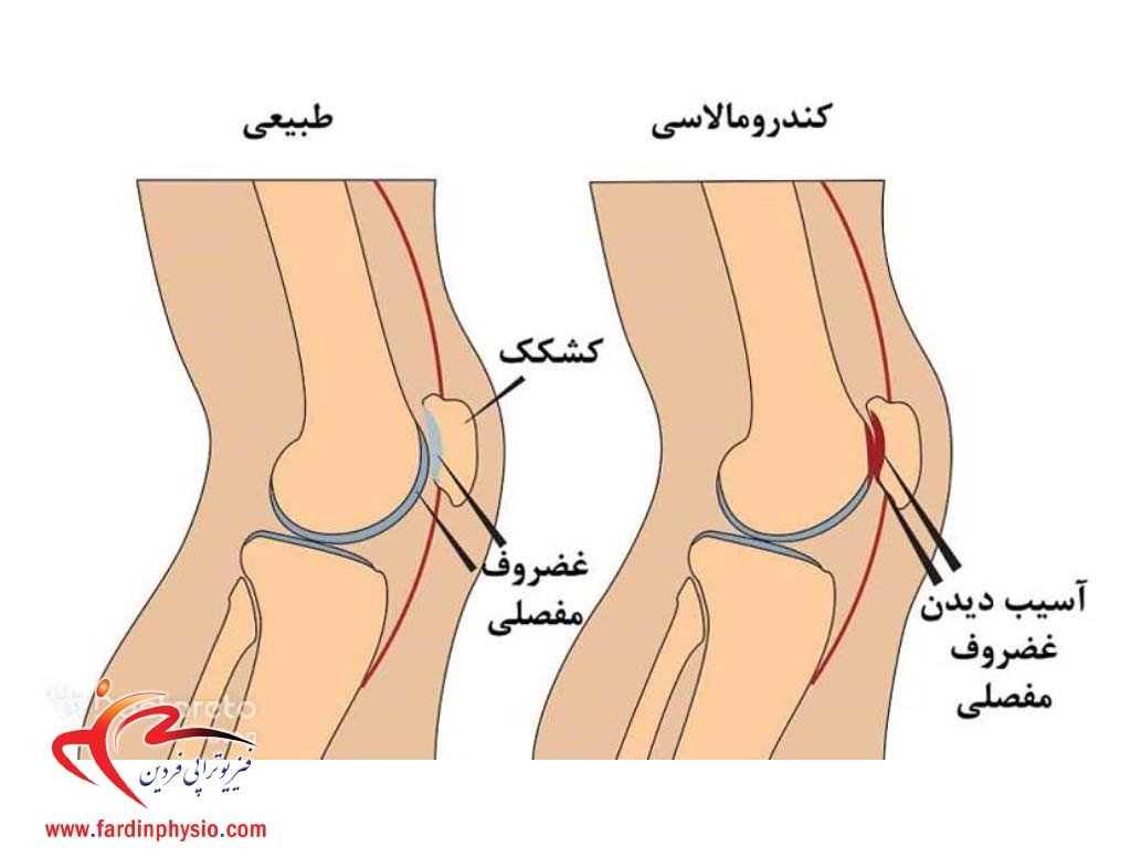 You are currently viewing کندرومالاسی کشکک زانو چیست و نقش فیزیوتراپی در بهبود آن