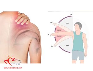 درباره این مقاله بیشتر بخوانید فروزن شولدر شانه چیست ؟