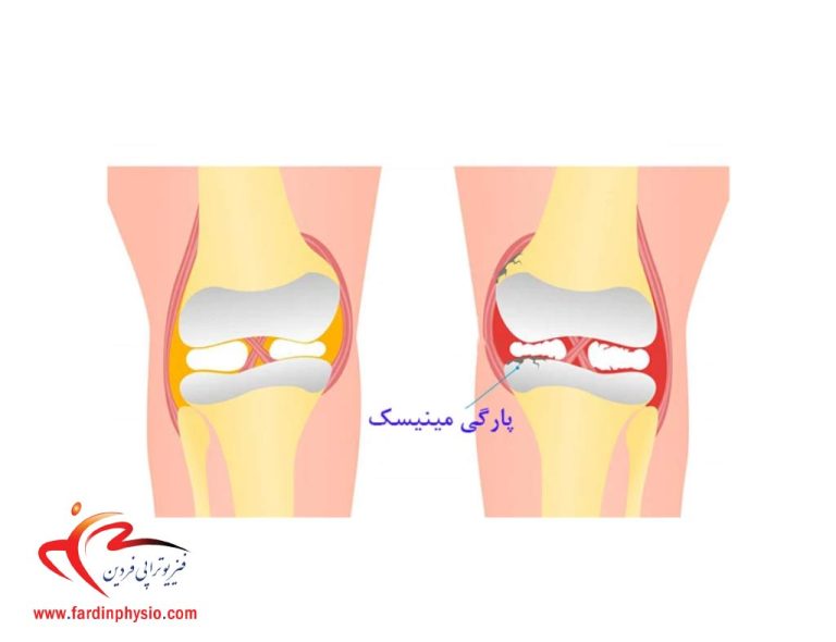 درباره این مقاله بیشتر بخوانید درمان آسیب و پارگی مینیسک زانو با فیزیوتراپی و بدون جراحی