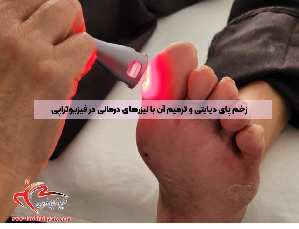 You are currently viewing زخم پای دیابتی و ترمیم آن با لیزرهای درمانی در فیزیوتراپی