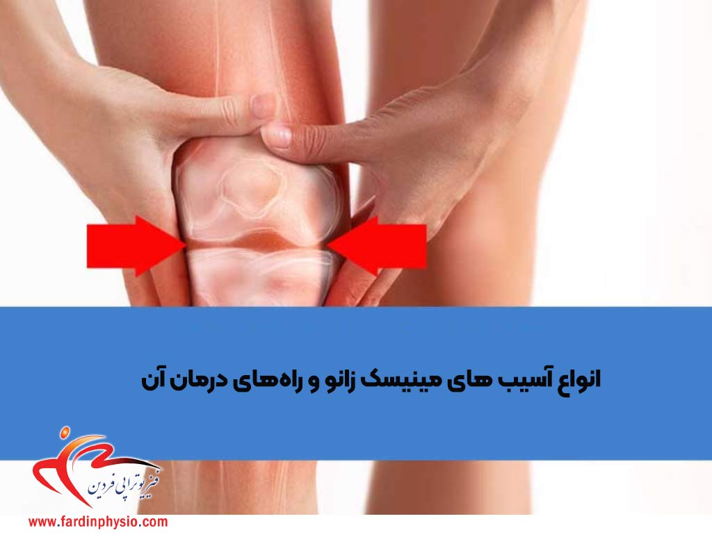 You are currently viewing انواع آسیب های مینیسک زانو و راه‌های درمان آن
