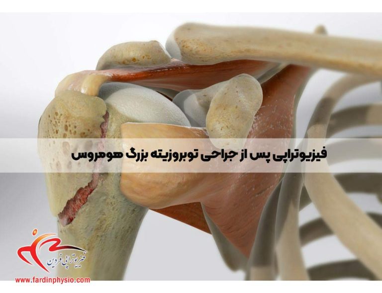 درباره این مقاله بیشتر بخوانید فیزیوتراپی پس از جراحی توبروزیته بزرگ هومروس: یک رویکرد جامع بازتوانی