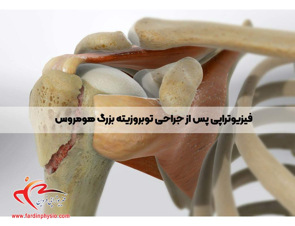 You are currently viewing فیزیوتراپی پس از جراحی توبروزیته بزرگ هومروس: یک رویکرد جامع بازتوانی