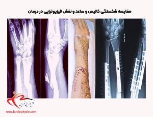 درباره این مقاله بیشتر بخوانید مقایسه شکستگی کالیس و ساعد و نقش فیزیوتراپی در درمان