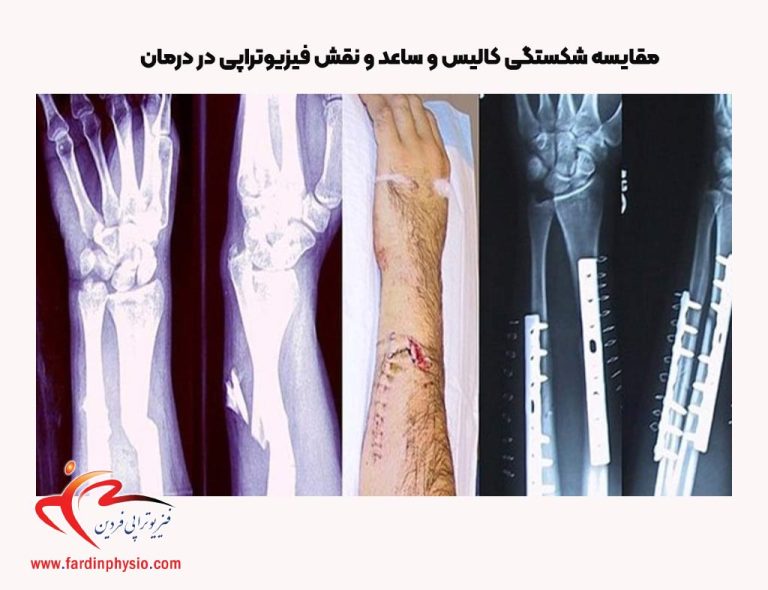 درباره این مقاله بیشتر بخوانید مقایسه شکستگی کالیس و ساعد و نقش فیزیوتراپی در درمان