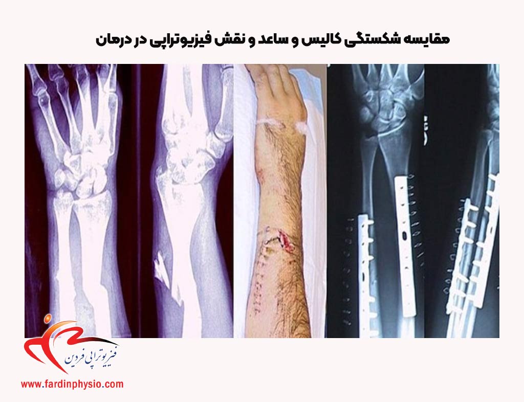 You are currently viewing مقایسه شکستگی کالیس و ساعد و نقش فیزیوتراپی در درمان