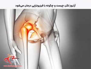 درباره این مقاله بیشتر بخوانید آرتروز لگن چیست و چگونه با فیزیوتراپی درمان می‌شود